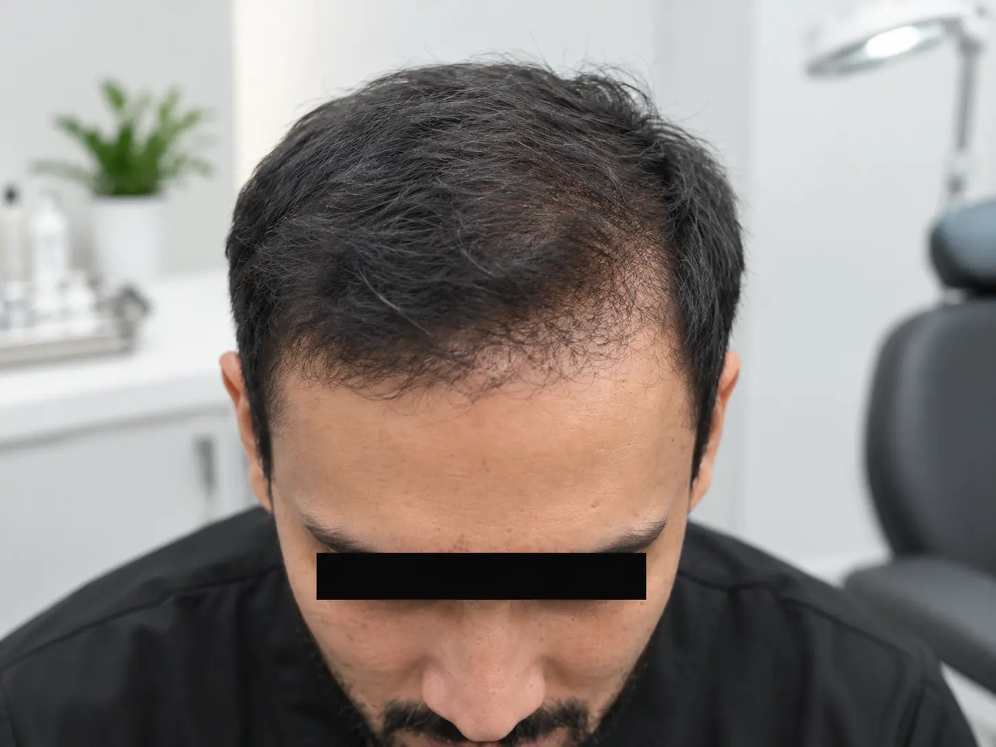 hair shedding treatments at Skinology Multan