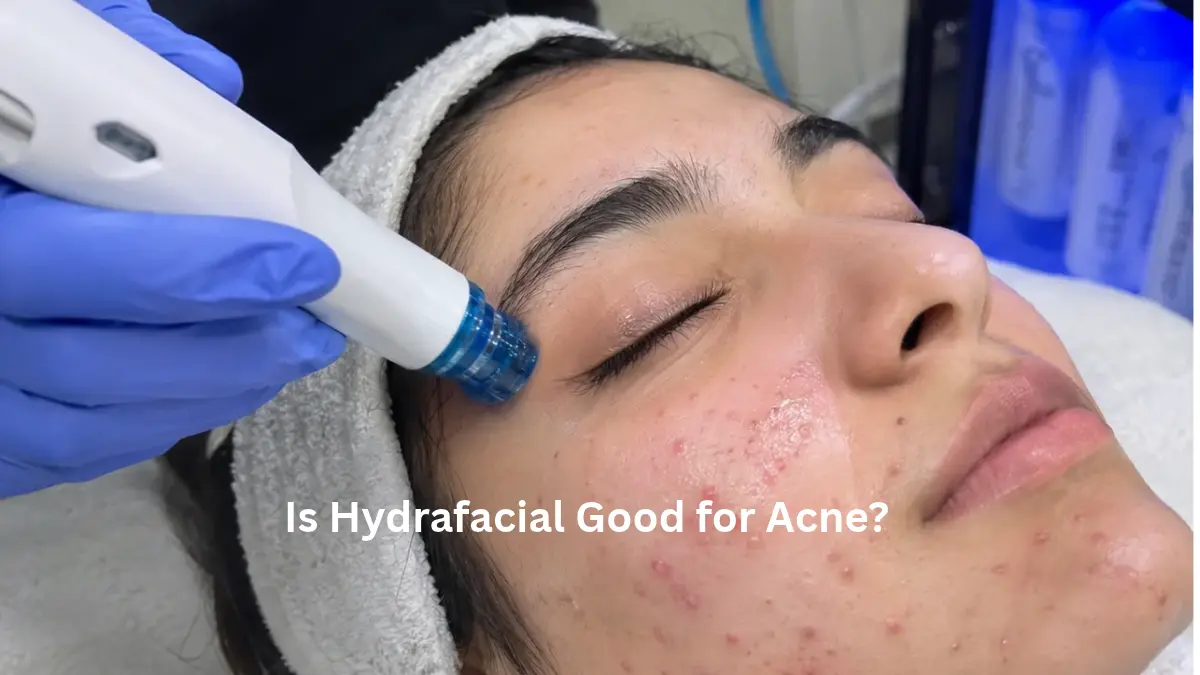 HydraFacial for Acne