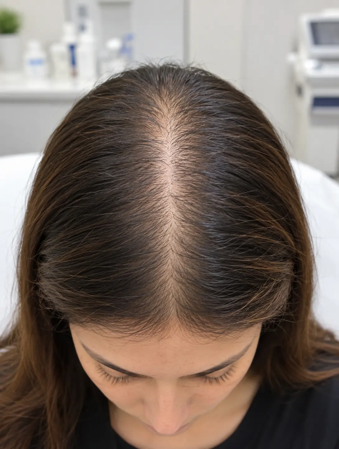 Scalp conditions in Multan by Skinology