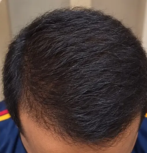 Hair transplant after results at Skinology Multan