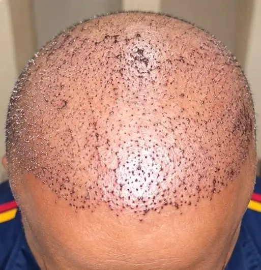 Hair transplant before at Skinology Multan