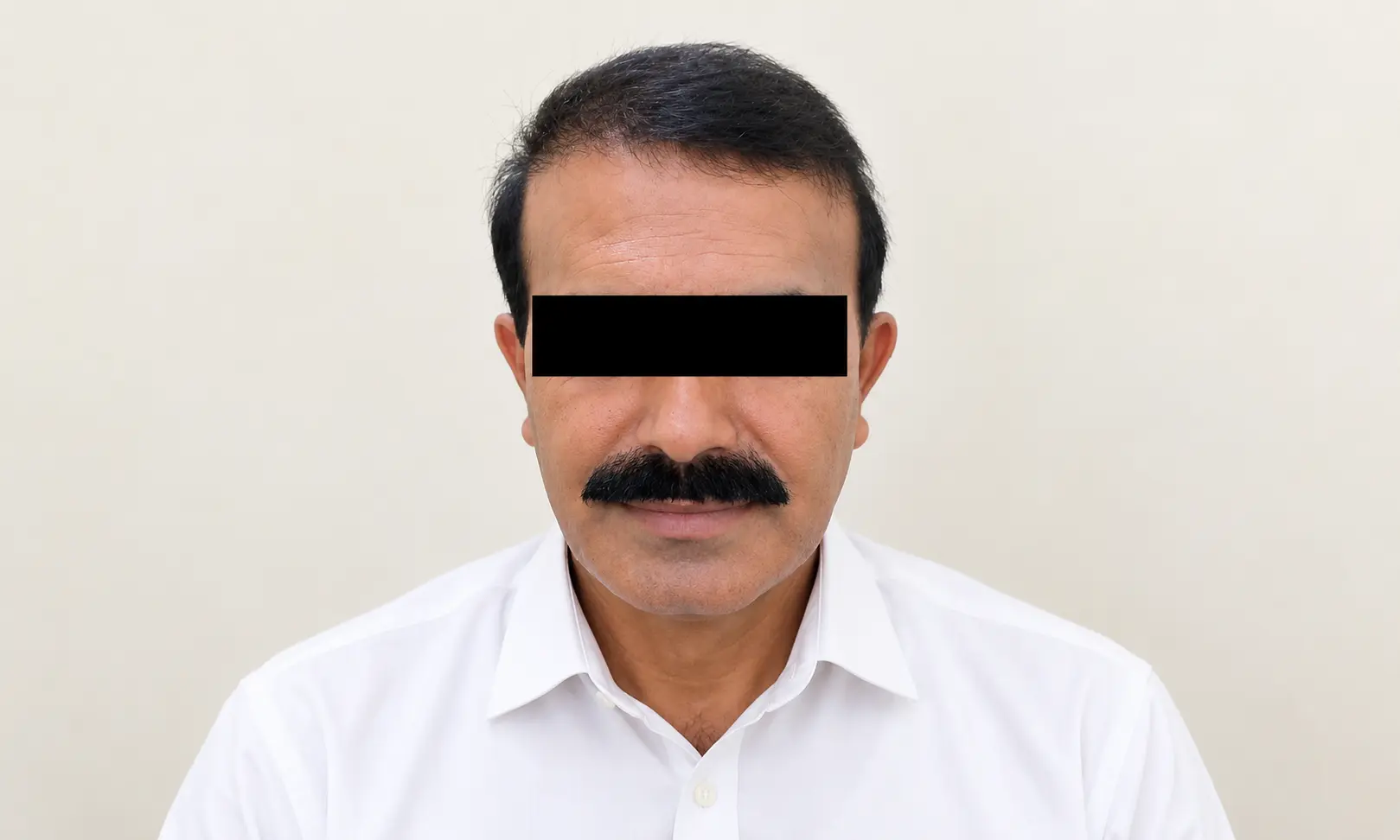 male pattern hair loss treatment in Skinology Multan